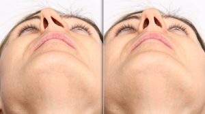 چگونه سپتوپلاستی و کاهش شاخک‌ها می‌تواند به بهبود تنفس کمک کند؟